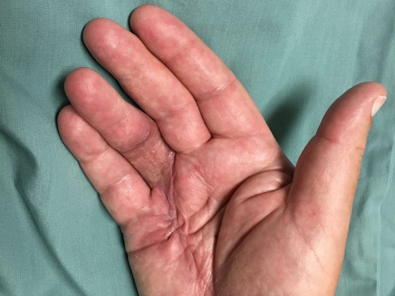 Hand affected by Dupuytren's disease, shown six weeks after the Dermofasciectomy
